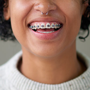 Dental Implants Slide 1